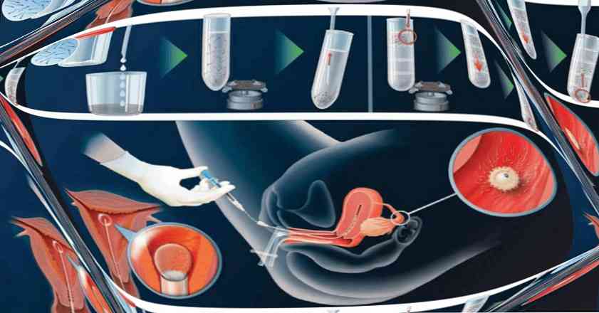 Sperm bank home insemination