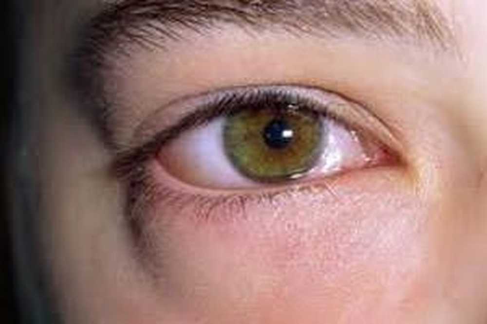 Почему отек глаз. Хемоз конъюнктивы отек.