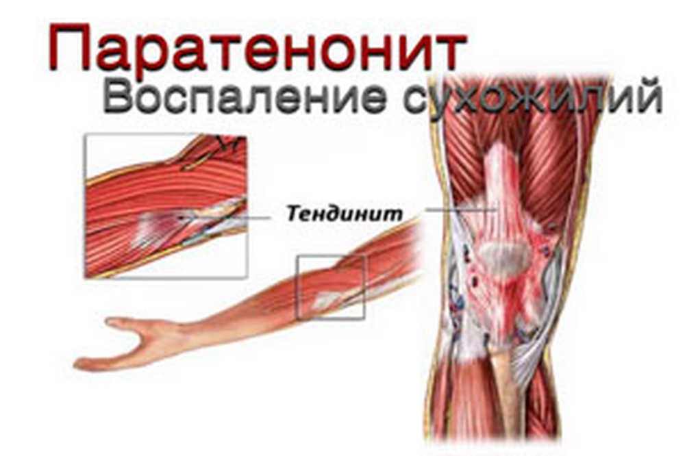 Тендинит сухожилий мышц это