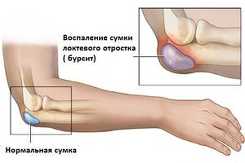 Бурсит локтевого отростка