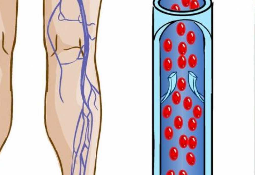 Лечение тромбоза вен. Флебит поверхностных вен. Тромбоз глубоких вен (ТГВ) – что это такое?. Флеботромбоз осложнения.