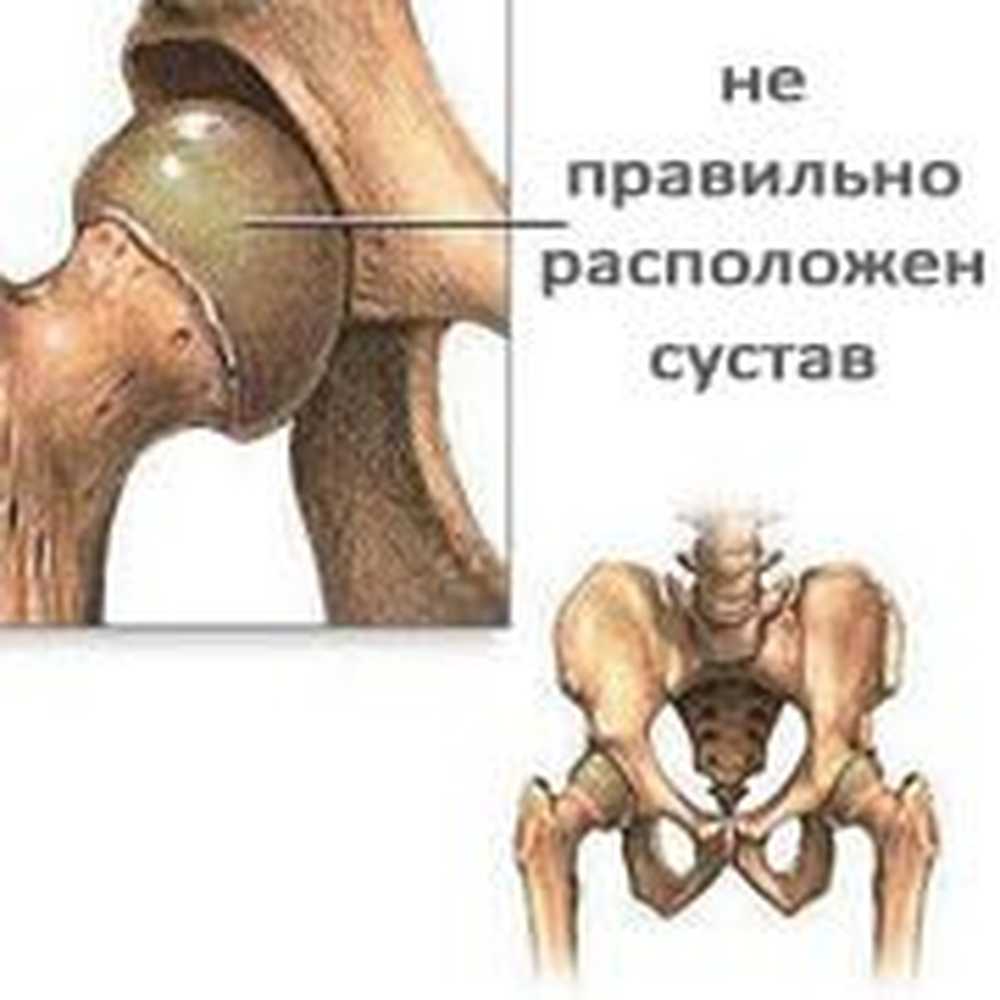 Презентация дисплазия тазобедренных суставов