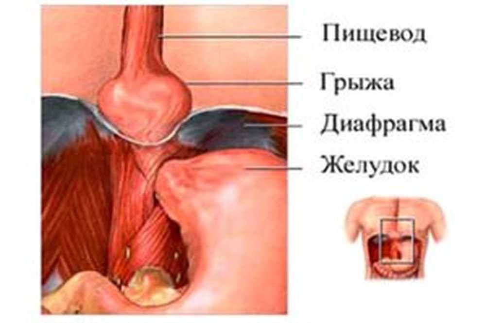 hipertónia versben aronia hipertónia esetén