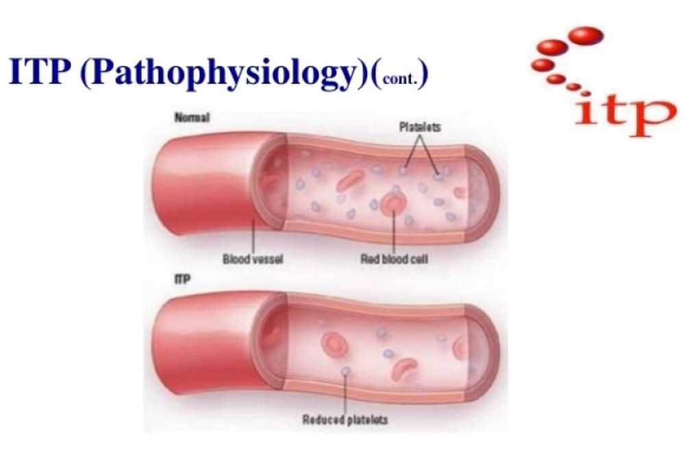 У больного тромбоцитопенией. Тромботическая тромбоцитопеническая пурпура. Идиопатическая тромбоцитопения пурпура. Идиопатическая тромбоцитопеническая пурпура сыпь. Патогенез иммунной тромбоцитопенической пурпуры.