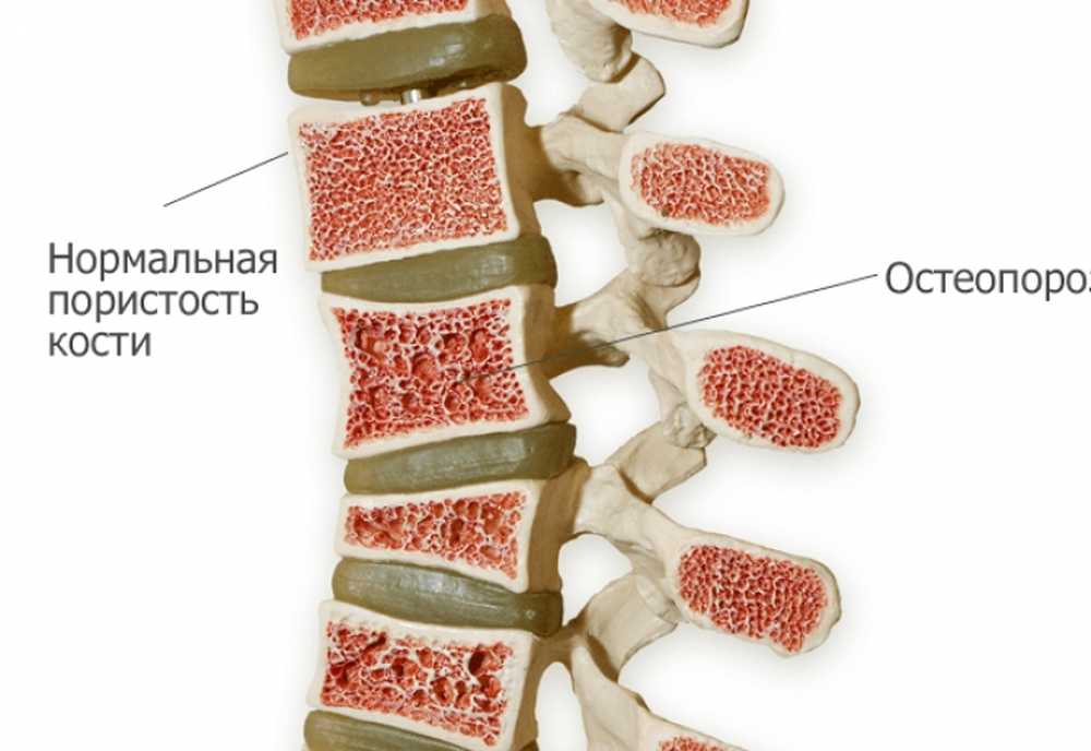 Остеопороз что это. Нормальная кость и остеопороз. Ювенильный остеопороз. Костная ткань остеопороз. Остеопороз позвоночника поясничного.