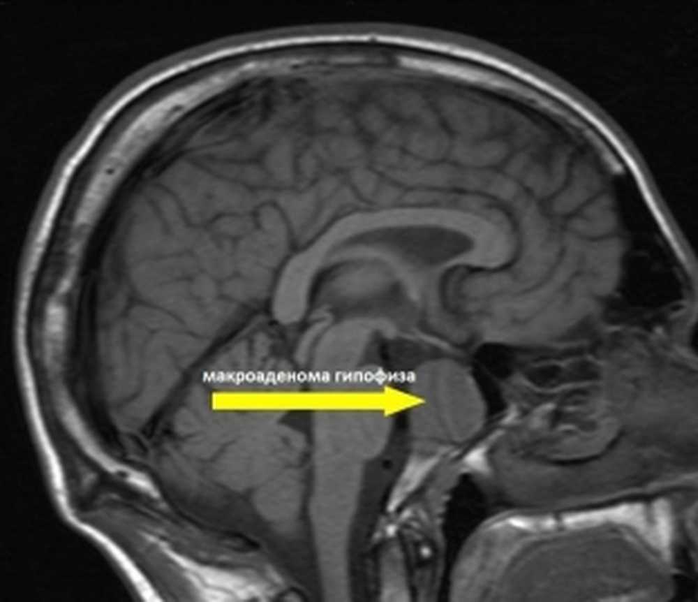 Мрт гипофиза. Мрт микроаденома гипофиза мрт. Эндоселлярная аденома гипофиза. Микроаденома гипофиза снимок мрт. Соматотропинома гипофиза.