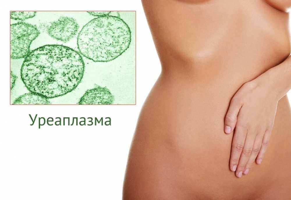 Ureaplasma urealyticum. Уреаплазмоз симптомы выделения. Микоплазмоз и уреаплазмоз у женщин.