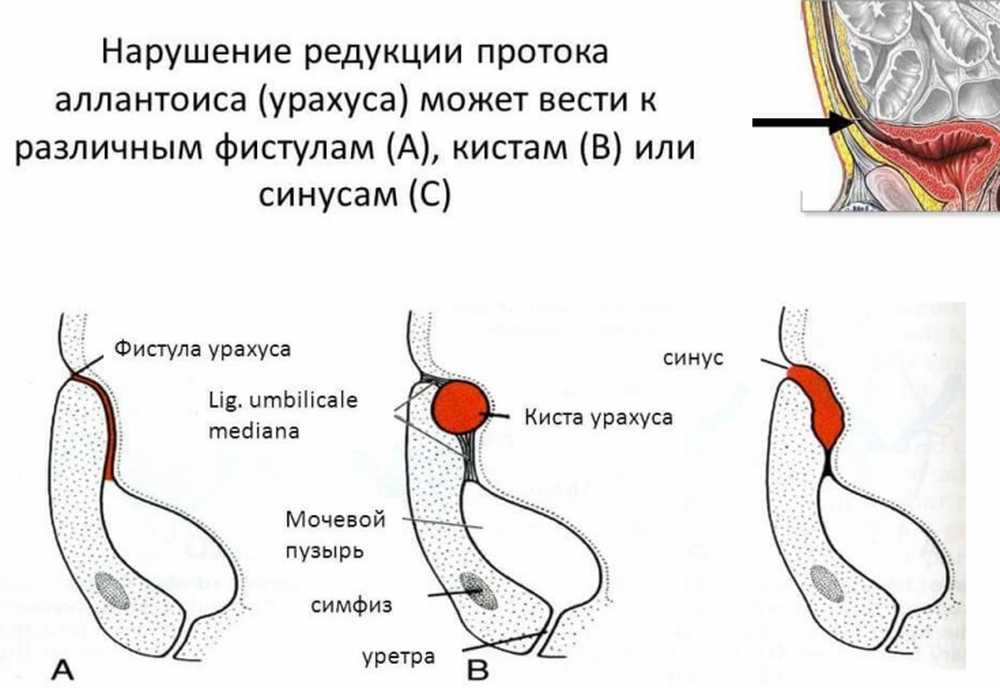 Киста урахуса. Аномалия мочевого протока урахуса у новорожденных. Свищ пупка незаращение мочевого протока урахуса.