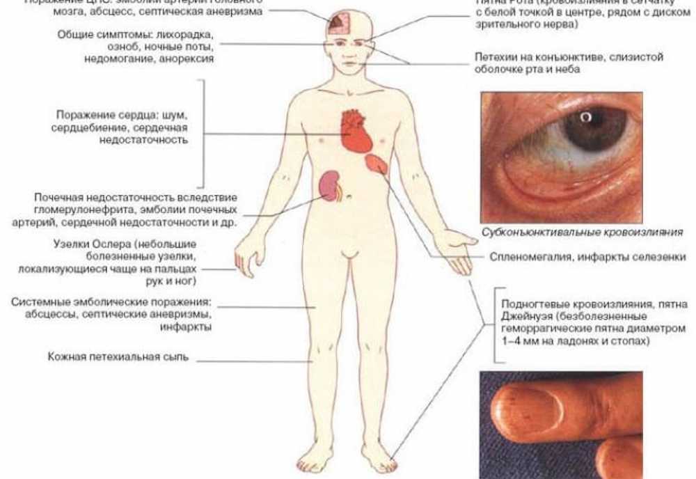 Поражение со. Острая ревматическая лихорадка симптомы. Острая ревматическая лихорадка у детей клинические симптомы. Ревматическая лихорадка клинические симптомы. Поражение нервной системы у детей при острой ревматической лихорадке.