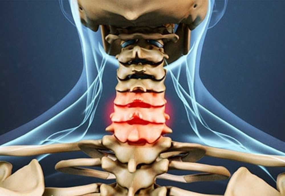 Растяжение связок шейного отдела