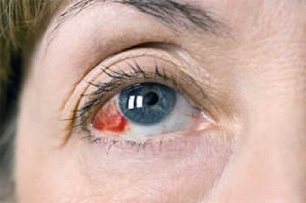 kapilare u oku hipertenzije