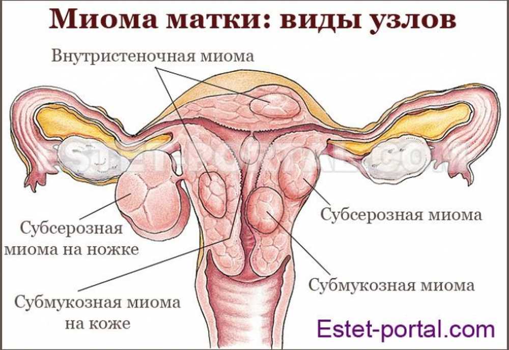 Месячные при миоме. Субмукозное расположение узла. Многочисленные миомы матки. Множественная миома матки.