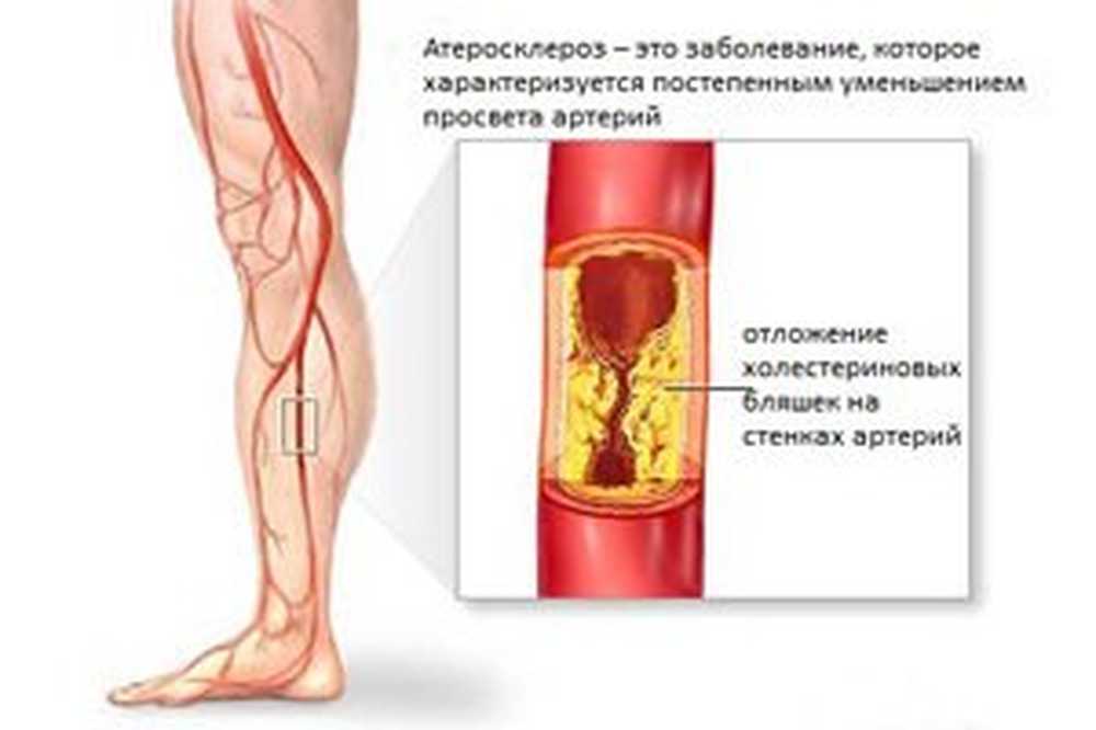 ateroskleroza donjih ekstremiteta)