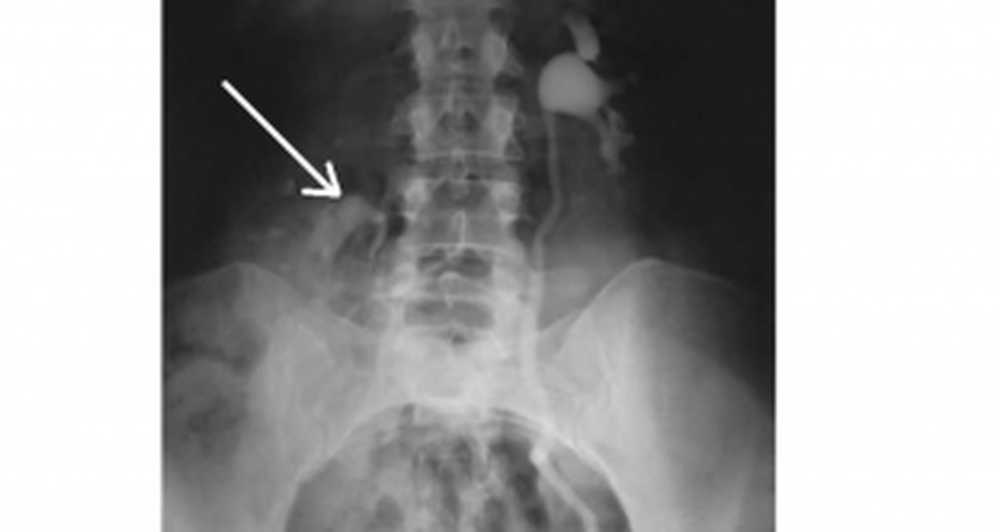 Снимок почек. Опущение почки рентген. Экскреторная урография нефроптоз. Нефроптоз почки урография. Блуждающая почка рентген.