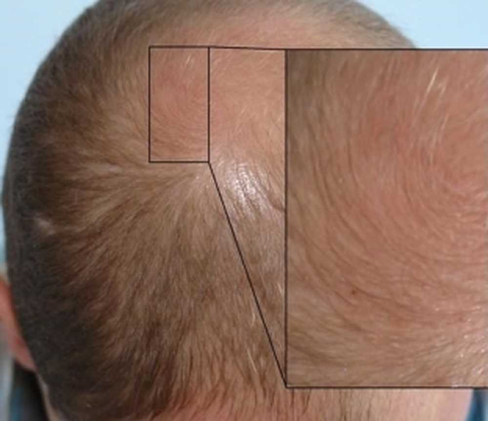 Плазмотерапия волосистой части головы сколько нужно процедур