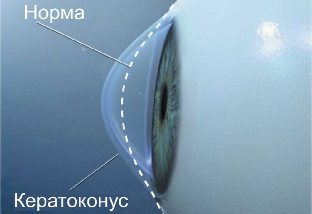 Кератоконус. Кератоконус и астигматизм. Роговичный астигматизм (кератоконус). Кератоконус роговицы глаз.