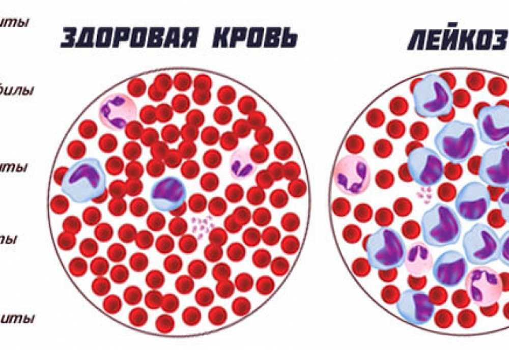 Лейкоз последствия. Лейкоз клетки крови. Клетки крови при лейкозе.