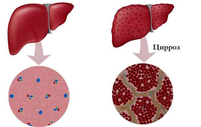 hipertenzija, problema s jetrom