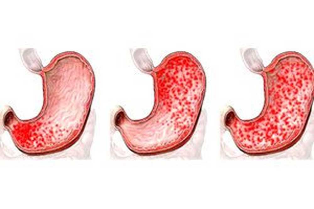Povezanost erozivnog gastritisa i hipertenzije