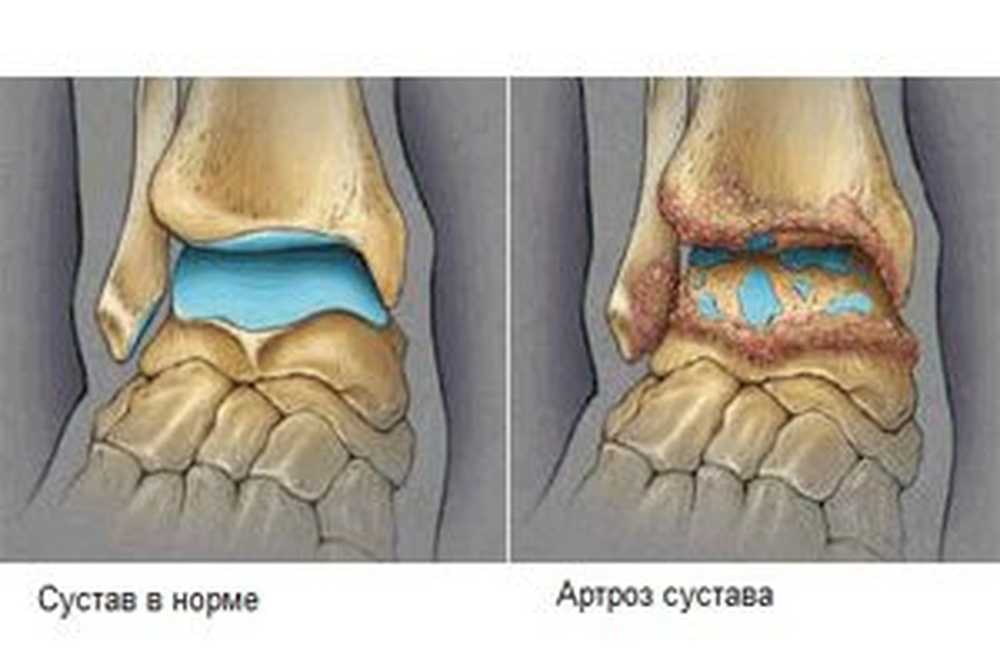 liječenje deformirajuće artroze zgloba gležnja 2 stupnja)