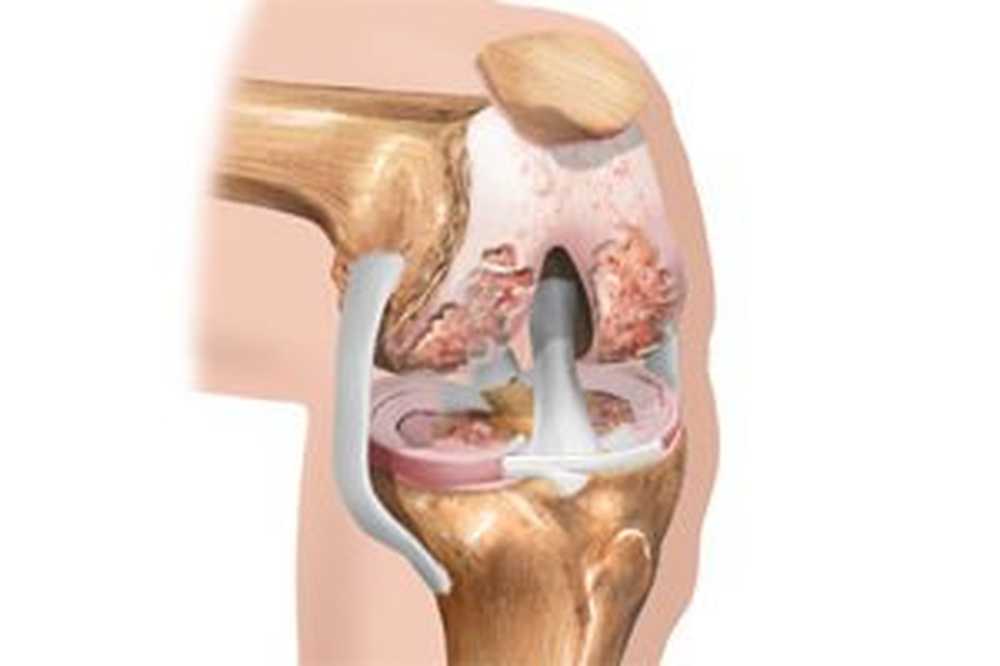 simptomi i liječenje post- traumatske artroze liječenje osteoartritisa alloplant