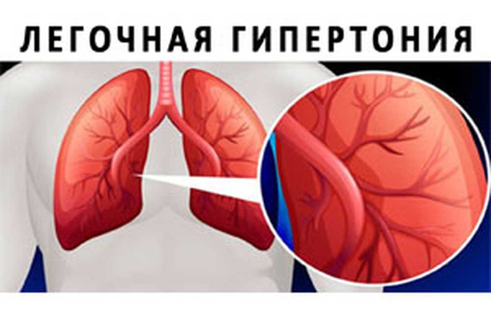 Hipertenzija u plućnoj cirkulaciji