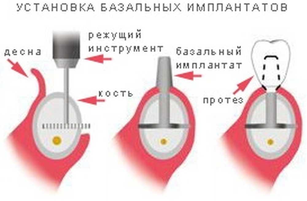 Базальная имплантация. Базальная одноэтапная имплантация. Кортикальные импланты. Базальная и кортикальная имплантация. Кортикальные базальные импланты.