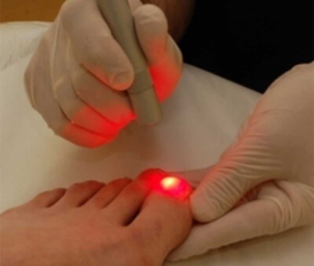 Лазерная терапия грибка ногтей