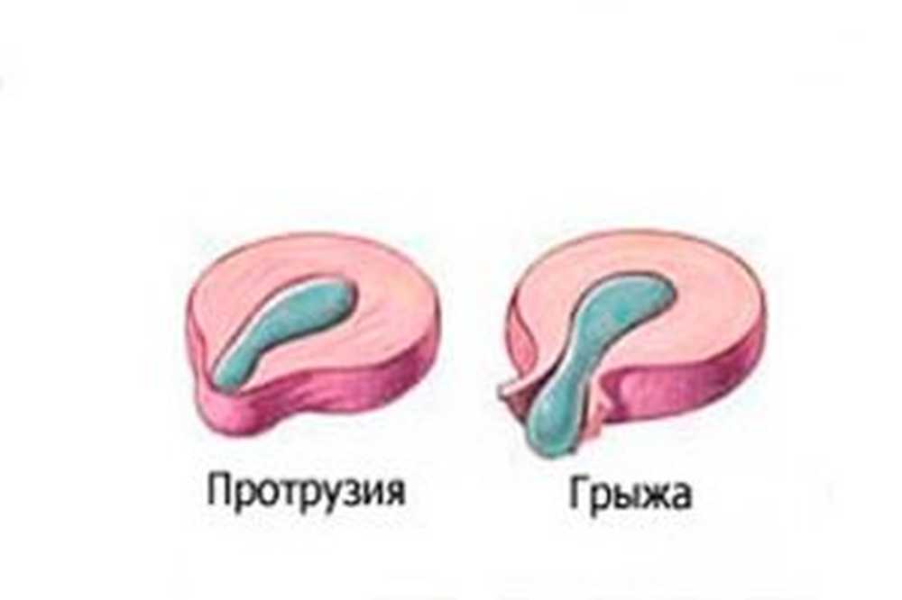 Протрузия это. Отличие грыжи от протрузии. Различия протрузии от грыжи. Протрузия и грыжа разница. Экструзия и протрузия разница.