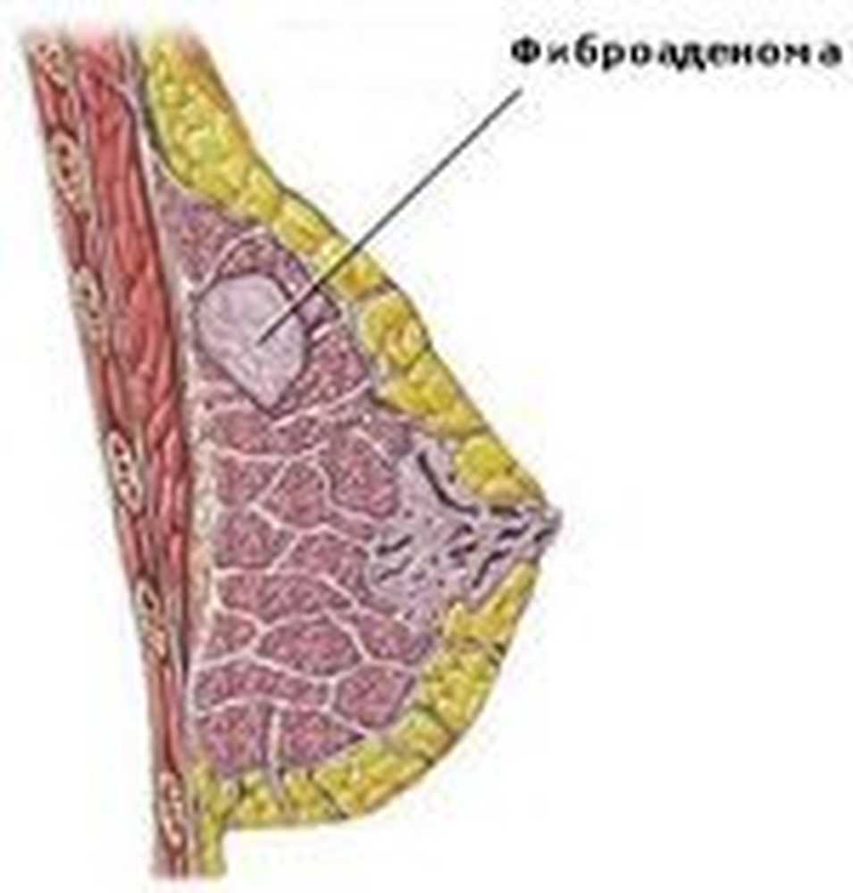 Фиброаденома молочной железы что. Фиброаденома молочной железы гистогенез. Фиброзно-кистозная мастопатия фиброаденома. Листовидная мастопатия. Фиброаденома молочной железы мастопатия.