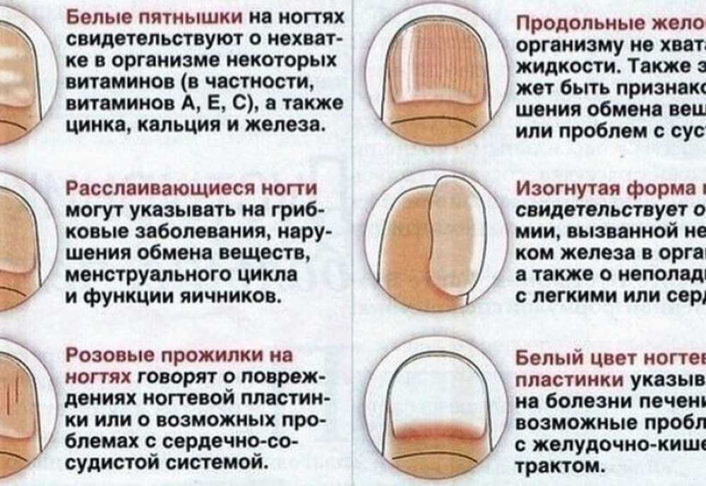 Определить болезнь по ногтям