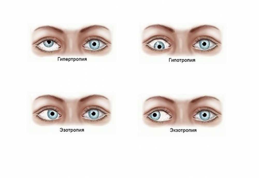 Что такое ленивый глаз. Гимнастика для глаз от косоглазия для детей. Классификация косоглазия офтальмология. Скрытое косоглазие. Упражнения для косоглазия у детей.