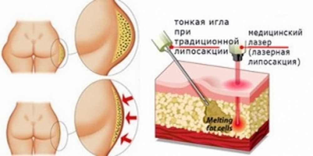 Лазерная липосакция. Лазерная липосакция ягодиц. Лазерный липолиз бедер. Лазерный липолиз схема. Голливудская лазерная липосакция.