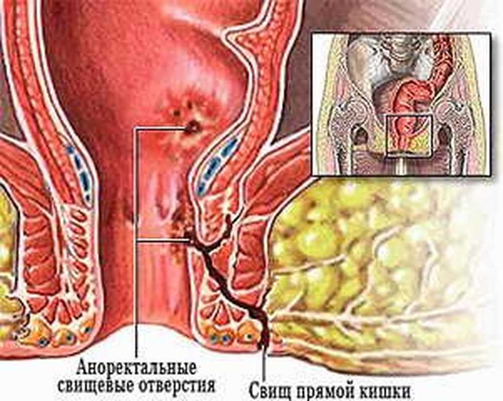Парапроктит параректальный свищ