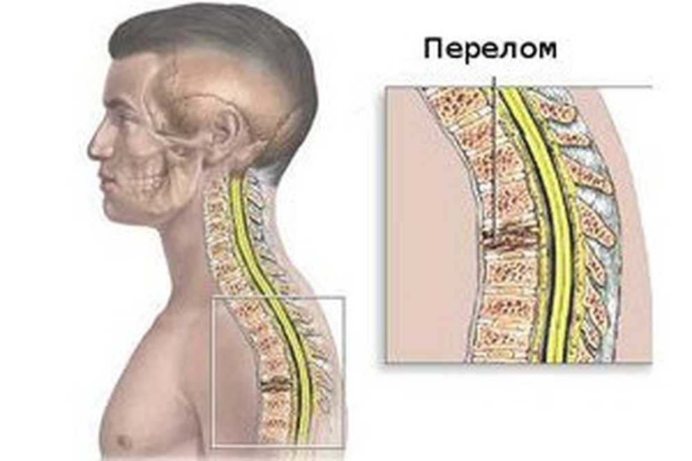 Перелом грудного отдела позвоночника. Компрессионный перелом позвоночника т6. Компрессионный перелом позвоночника th5. Компрессионный перелом позвоночника в грудном отделе 12. Компрессионный перелом 4 позвонков.