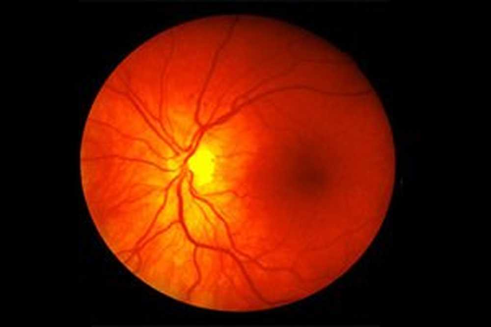 Dijabetička angiopatija mrežnice: uzroci oštećenja oka i liječenja