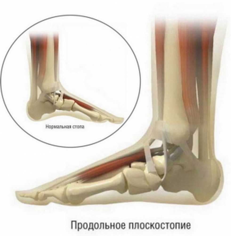 Продольное плоскостопие. Стопы с продольным плоскостопием. Продольное плоскостопие 2 степени. Продольное плоскостопие травматология. Нормальный свод стопы.