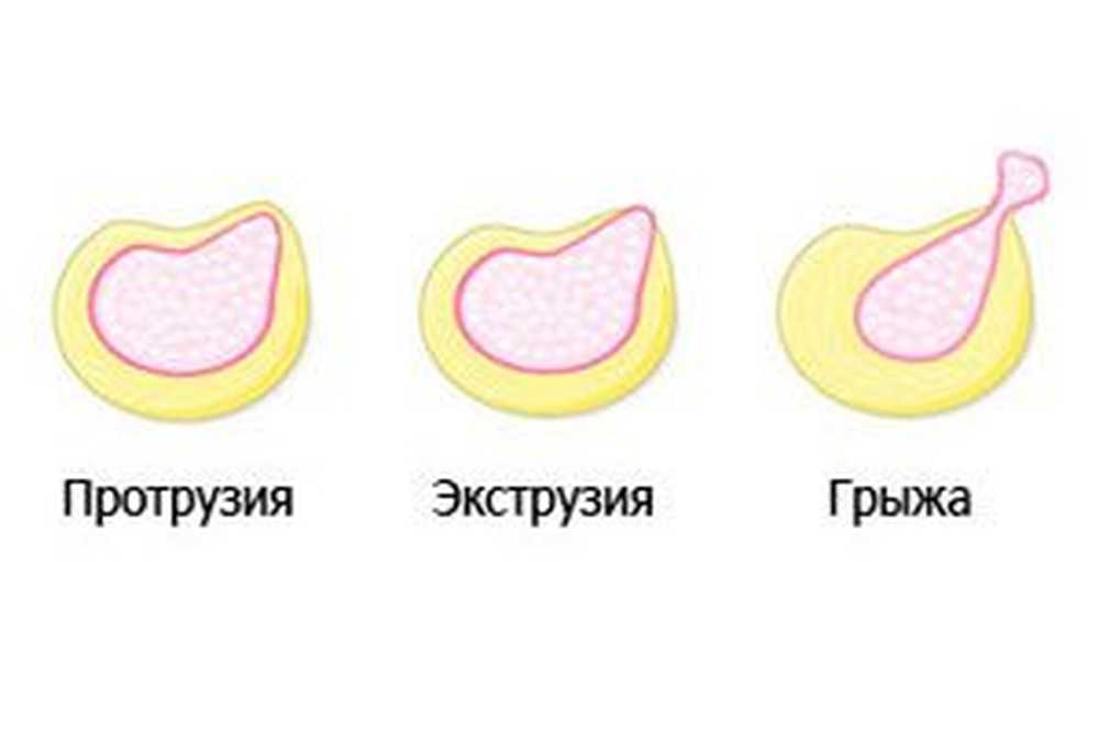 Экструзия диска. Экструзия позвоночного диска. Экструзия и протрузия дисков позвоночника что это такое. Протрузия экструзия грыжа. Экструзия и протрузия разница.