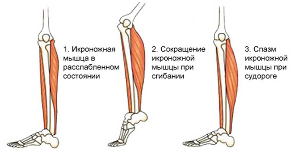 grčevi u zglobu telećeg mišića)