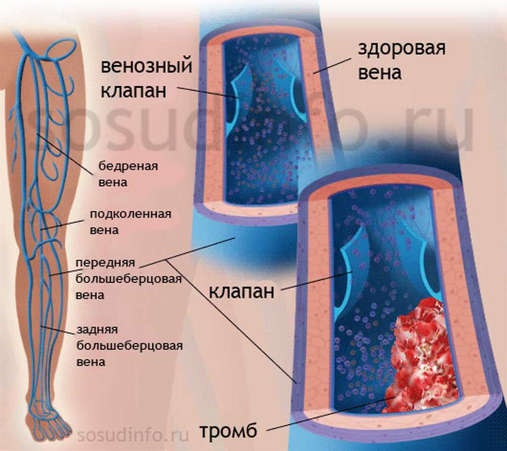 Как проверить есть ли в организме тромбы. Тромбоз клапана глубоких вен нижних конечностей. Тромбоз глубоких вен клиника. Венозные клапаны ноги сосуды. Венозный клапан нижних конечностей.